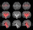 Es el primer estudio que mide con resonancia magnética la mielinización cerebral de los recién nacidos. FOTO Pujol et al., 2025 | ISGlobal