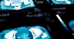 La prueba de antígeno prostático específico (PSA) es una herramienta clave para la detección temprana del cáncer de próstata. FOTO Getty