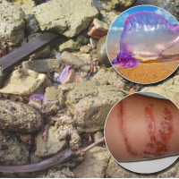 La fragata portuguesa fue avistada en las playas de Necoclí. En detalle, su apariencia y las lesiones que provoca su contacto. Fotos: Corporurabá, CVS y cortesía.