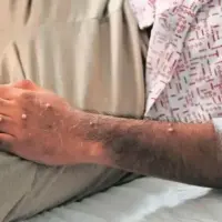 Las llagas aparecen entre uno y cinco días después de los primeros síntomas. FOTO CORTESÍA OMS.