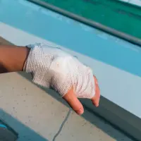 Las manos son la extremidad más afectada por la manipulación de pólvora en Antioquia, con 13 casos. FOTO: GETTY