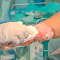 40 personas en Antioquia han sufrido lesiones grado 2 y 3, que implican en muchos casos daños irreversibles. FOTO: GETTY