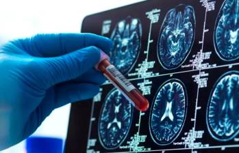 Según estimaciones, en el mundo hay alrededor de 57 millones de pacientes con Alzheimer. Los tratamientos todavía son materia de estudio. FOTO: Getty