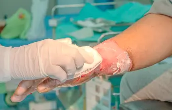 40 personas en Antioquia han sufrido lesiones grado 2 y 3, que implican en muchos casos daños irreversibles. FOTO: GETTY