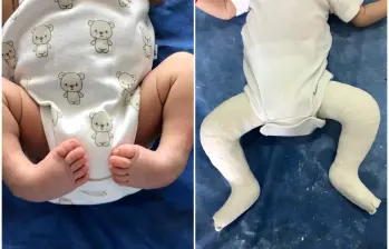 A la izquierda, un recién nacido con pie equinovaro; a la derecha, un niño con la férula utilizada en el tratamiento Ponseti. FOTOS cortesía Clínica Foscal