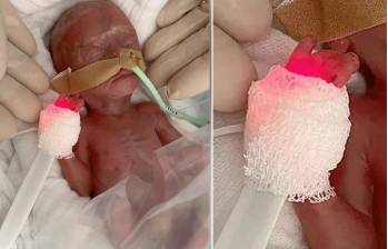 Una bebé en Alemania nació 16 semanas antes de la fecha prevista y con un peso de 300 gramos. FOTOS: Hospital Universitario de Magdeburgo