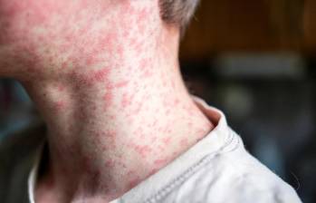 El virus del sarampión, altamente contagioso y potencialmente mortal para niños, ha encontrado en México su epicentro continental con más de 11.200 casos confirmados. FOTO: Getty