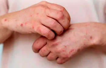 Casos de mpox variante clado Ib en Colombia. Foto: cortesía Prensa Latina