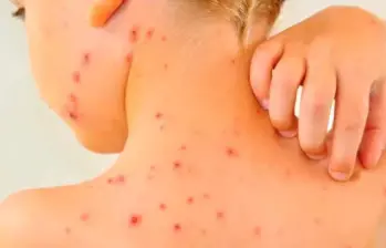 El equipo epidemiológico de la Secretaría de Salud de Bello mantendrá por lo menos tres semanas más la vigilancia hasta que no haya un solo caso de varicela. IMAGEN ILUSTRATIVA.