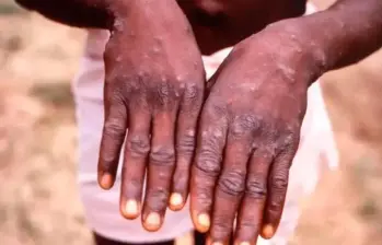 Las llagas aparecen entre uno o cinco días después de los primeros síntomas. FOTO GETTY.