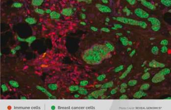 Células inmunes interaccionando con el cáncer de mama. FOTO cortesía Reveal Genomics