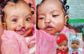El efecto mágico de poder sonreír: termina misión para operar a 100 niños con labios y encía fisurada en Medellín