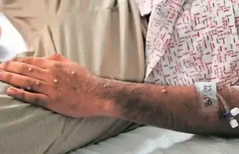 Las llagas protuberencias aparecen entre uno y cinco días después de los primeros síntomas. FOTO: CORTESÍA OMS