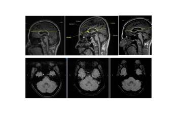 Resonancias magnéticas de los cerebros de los pacientes estudiados. FOTO cortesía Natalia Acosta Baena