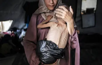 Muhammad Zakariya Ayyoub al-Matouq, un niño de un año y medio en la ciudad de Gaza, enfrenta una desnutrición que pone en peligro su vida a medida que la situación humanitaria empeora debido a los continuos ataques y bloqueos israelíes FOTO: Getty