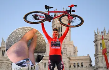 El ciclista esloveno cuatro veces ganador de La Vuelta a España, Primoz Roglic, mostró cómo quedó su pierna tras ser atropellado en Austria. Fotos: Getty Images y primozroglic