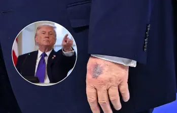 Los hematomas en la mano de Donald Trump que lo ponen bajo la lupa en redes socialesFotos: Getty Images / redes sociales