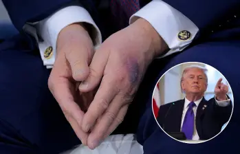 Los hematomas en la mano de Donald Trump que lo ponen bajo la lupa en redes sociales. Fotos: Getty Images 