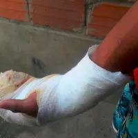 El menor lesionado tuvo que ser intervenido por las quemaduras sufridas con un volador dentro de su vivienda. FOTO: ARCHIVO - MAURICIO PALACIO