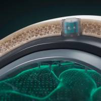 Para implantar el chip es necesario realizar una cirugía ambulatoria de 20 minutos. La ventaja del DOT es que no hace contacto directo con el cerebro. FOTO: Cortesía Motif Neurotech.