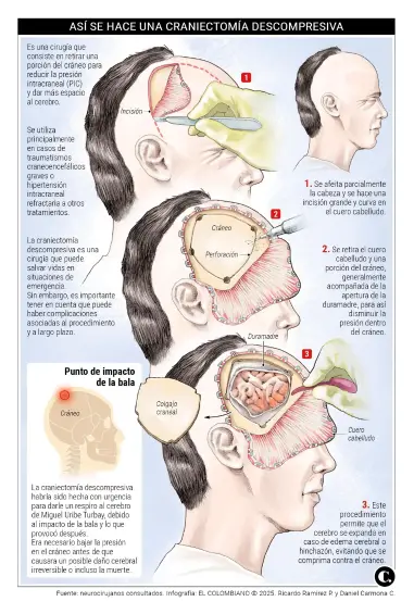 Miguel Uribe fue sometido a una <b>craniectomia descompresiva</b>; esta es una cirugía que consiste en retirar una porción del cráneo para reducir la presión intracraneal y dar más espacio al cerebro. Se utiliza principalmente en casos de traumatismos craneoencefálicos graves (ver gráfico).