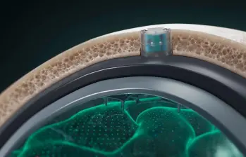 Para implantar el chip es necesario realizar una cirugía ambulatoria de 20 minutos. La ventaja del DOT es que no hace contacto directo con el cerebro. FOTO: Cortesía Motif Neurotech.