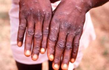 ¿Qué tan peligrosa es la mpox para los seres humanos? Foto: Getty