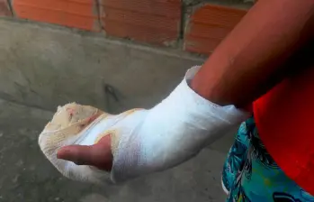 El menor lesionado tuvo que ser intervenido por las quemaduras sufridas con un volador dentro de su vivienda. FOTO: ARCHIVO - MAURICIO PALACIO