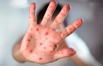 Las erupciones cutáneas aparecen entre 7 y 18 días después de la exposición al virus. FOTO Cortesía MinSalud
