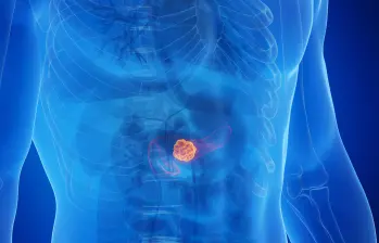 El cáncer de páncreas es uno de los más letales y resistentes a los tratamientos. Nuevas investigaciones apuntan a prolongar la supervivencia de los pacientes tras décadas sin avances significativos. FOTO AFP