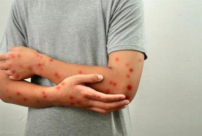 El sarampión se caracteriza por ser altamente infeccioso y por causar fiebre, congestión nasal y manchas en la piel. FOTO: Europa Press