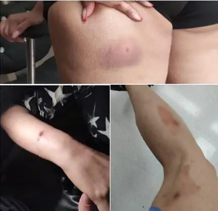 Impactos de perdigones en brazo y pierna por ataques con rifle deportivo en Medellín. Foto: Cortesía.