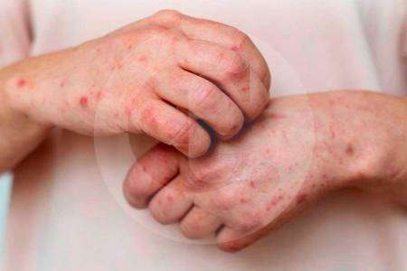 Se confirma segundo caso de mpox clado Ib en Colombia: se activó cerco epidemiológico de pasajero que llegó de Madrid a Bogotá