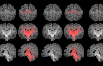 Es el primer estudio que mide con resonancia magnética la mielinización cerebral de los recién nacidos. FOTO Pujol et al., 2025 | ISGlobal