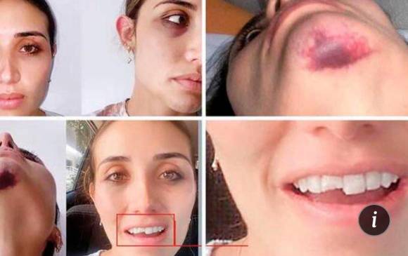 Los golpes le generaron a Pizarro heridas en el rostro y la barbilla. Tres de sus dientes y su tímpano fueron gravemente afectados. FOTO: Tomada de Twitter @MabelLaraNews.