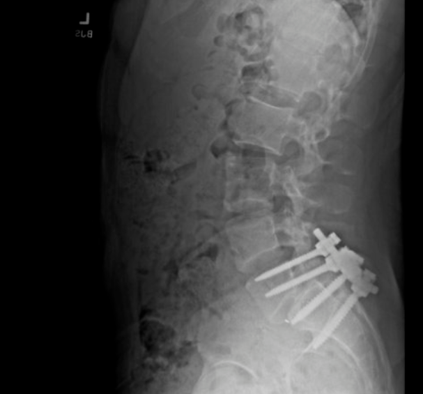 Esta sería la radiografía de la operación de espalda de Luigi Mangione. FOTO: Tomada de X @PepMangione