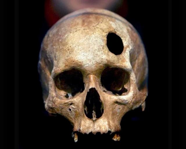 Un cráneo trepanado frontalmente. FOTO Efe.