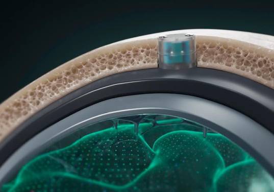 Para implantar el chip es necesario realizar una cirugía ambulatoria de 20 minutos. La ventaja del DOT es que no hace contacto directo con el cerebro. FOTO: <span class="mln_uppercase_mln">Cortesía Motif Neurotech.</span>