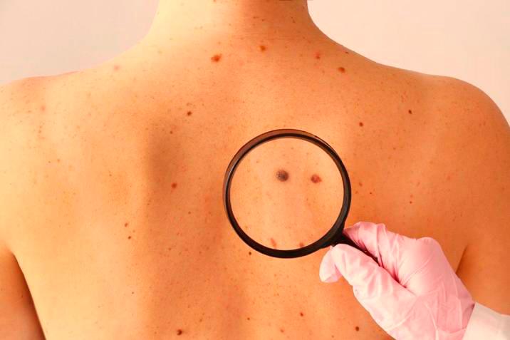 Antioquia es uno de los departamentos con peores cifras en cuanto a melanoma. FOTO: TOMADA DE INTERNET