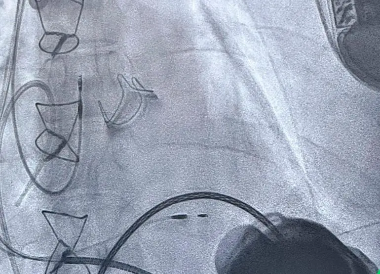 En Medellín se logró un hito médico para Colombia: realizaron dos implantes de corazón artificial en un solo día