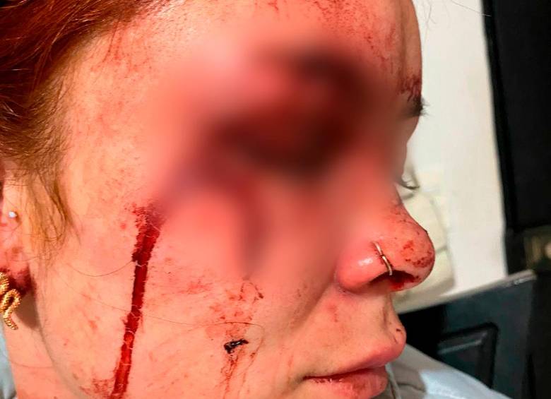 Así quedó el rostro de la joven golpeada por su expareja sentimental en Rionegro. FOTO: CORTESÍA DIARIORIENTE