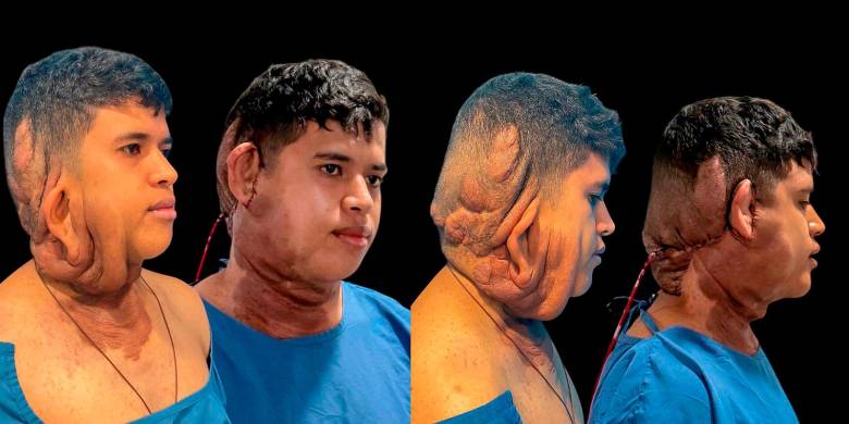 La NF1 —también conocida como enfermedad de Von Recklinghausen— es una malformación genética que genera cambios de coloración en la piel y tumores en el tejido nervioso. 