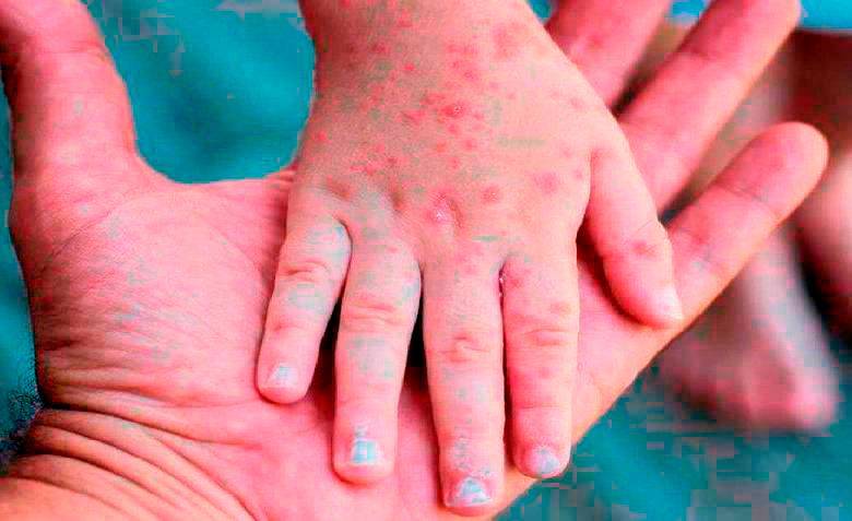 La OMS declaró la emergencia de carácter mundial por el crecimiento de la viruela del mono. FOTO: EFE