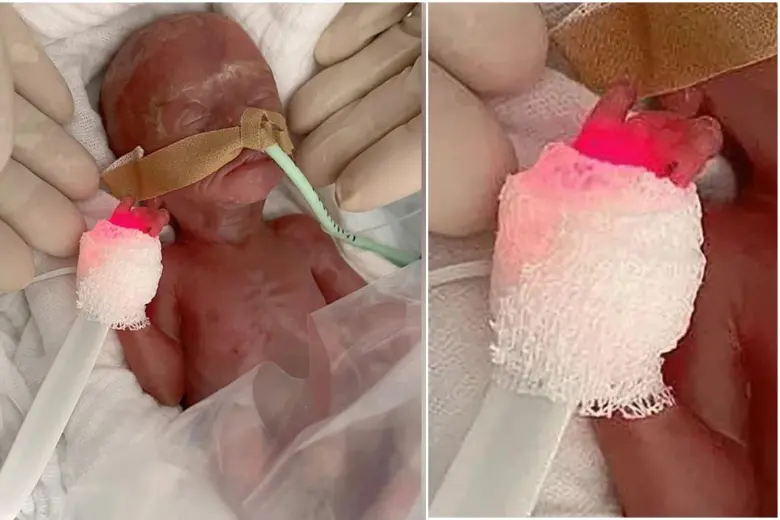 Ella es la bebé alemana que nació 16 semanas antes de tiempo. FOTOS: Hospital Universitario de Magdeburgo