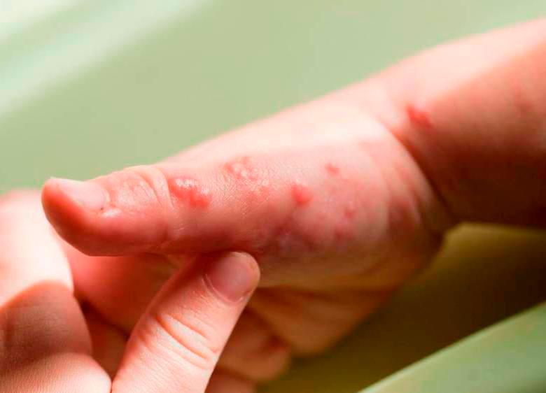 El virus, que produce lesiones en la piel, fue aislado en la Sede de Investigación Universitaria (SIU) de la UdeA. FOTO Cortesía 