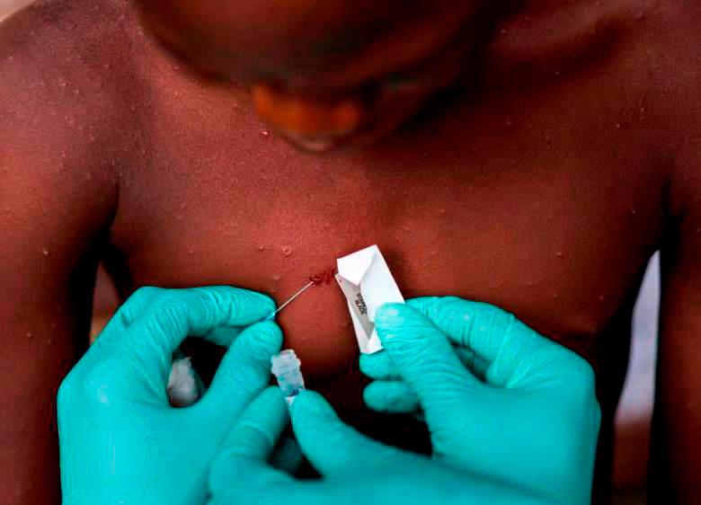 De acuerdo con la OMS, la viruela está presente en 50 países, incluido Colombia. FOTO: GETTY