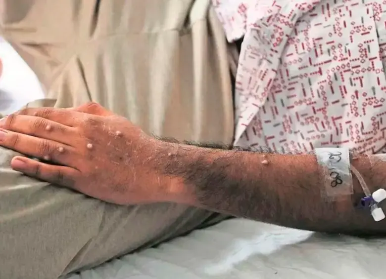 Las llagas protuberencias aparecen entre uno y cinco días después de los primeros síntomas. FOTO: CORTESÍA OMS