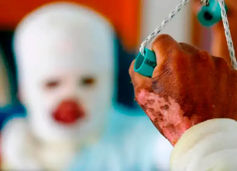 Dos de las personas resultaron con heridas de tercer grado, significa que muy seguramente quedarán con secuelas permanentes. FOTO: ARCHIVO EL COLOMBIANO