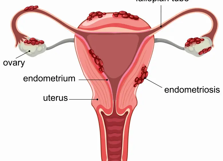 La endometriosis es una enfermedad crónica que, según la Organización Mundial de la Salud, puede causar dolor incapacitante y afectar significativamente la calidad de vida de millones de mujeres en el mundo. FOTO: Freepik.