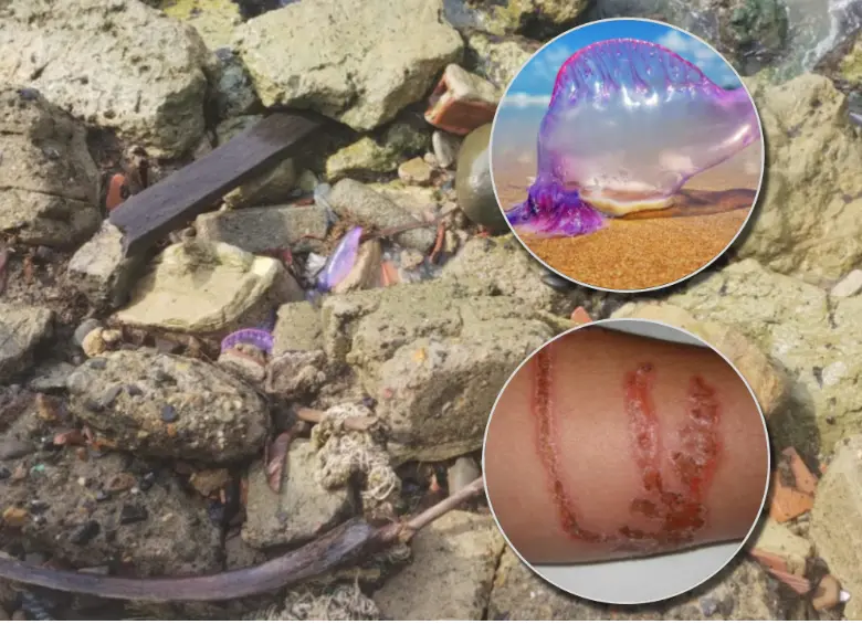 La fragata portuguesa fue avistada en las playas de Necoclí. En detalle, su apariencia y las lesiones que provoca su contacto. Fotos: Corporurabá, CVS y cortesía.